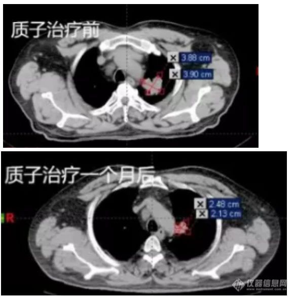 2019年，美国在治疗非小细胞肺癌方面有哪些新突破?