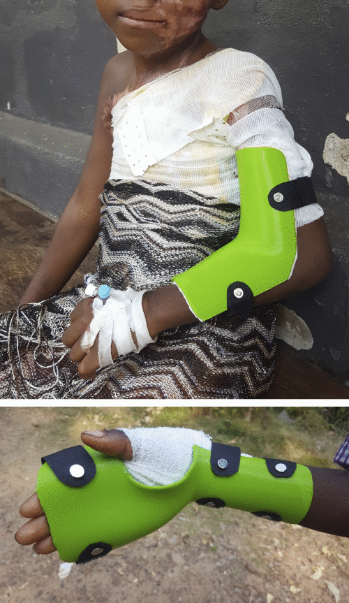 先临公益在非洲 | 3D Sierra Leone 医疗辅具定制项目为塞拉利昂带去关爱和帮助