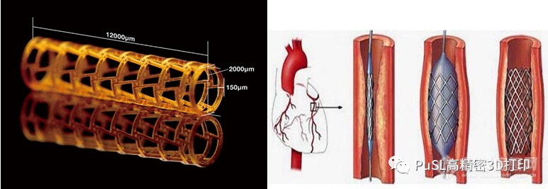 借助高精密3D打印技术释放介植入式医疗器械的创新维度