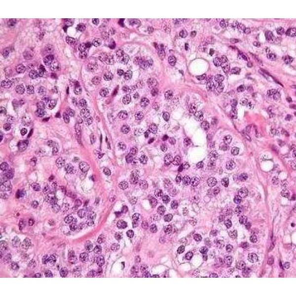 calu-6 人退行性癌细胞(通过STR鉴定)