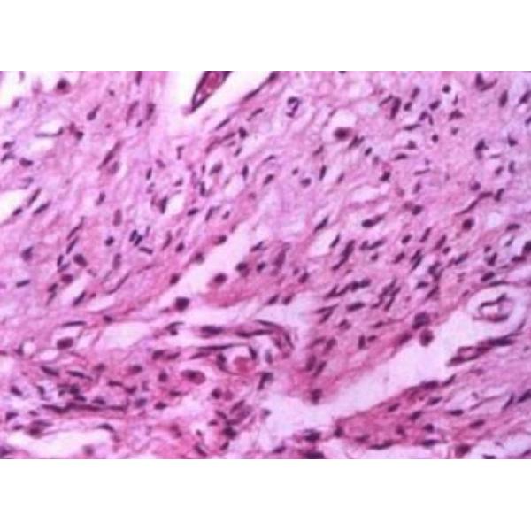 人子宫肌瘤细胞