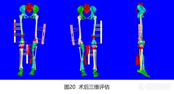 广州市第一人民医院借助智能数字技术实现下肢复杂畸形微创、三维精准矫正