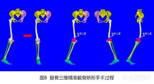 广州市第一人民医院借助智能数字技术实现下肢复杂畸形微创、三维精准矫正