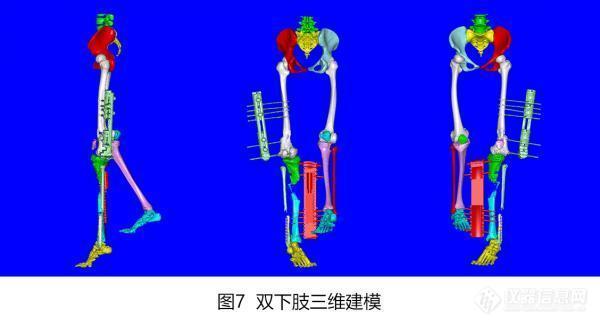 广州市第一人民医院借助智能数字技术实现下肢复杂畸形微创、三维精准矫正