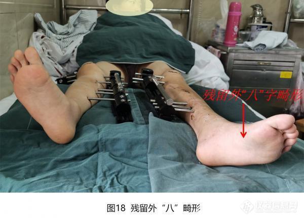 广州市第一人民医院借助智能数字技术实现下肢复杂畸形微创、三维精准矫正