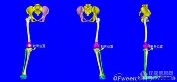 广州市第一人民医院借助智能数字技术实现下肢复杂畸形微创、三维精准矫正