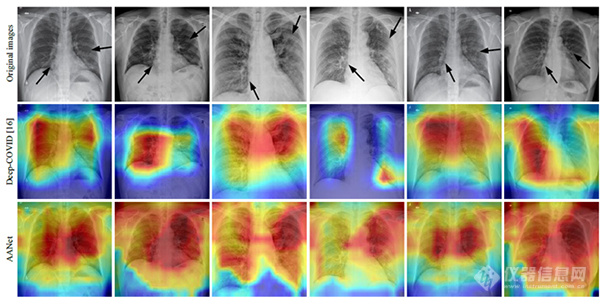 我国学者在人工智能辅助新冠肺炎影像诊断方面取得进展