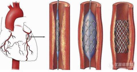 心脏支架(药物涂层支架)