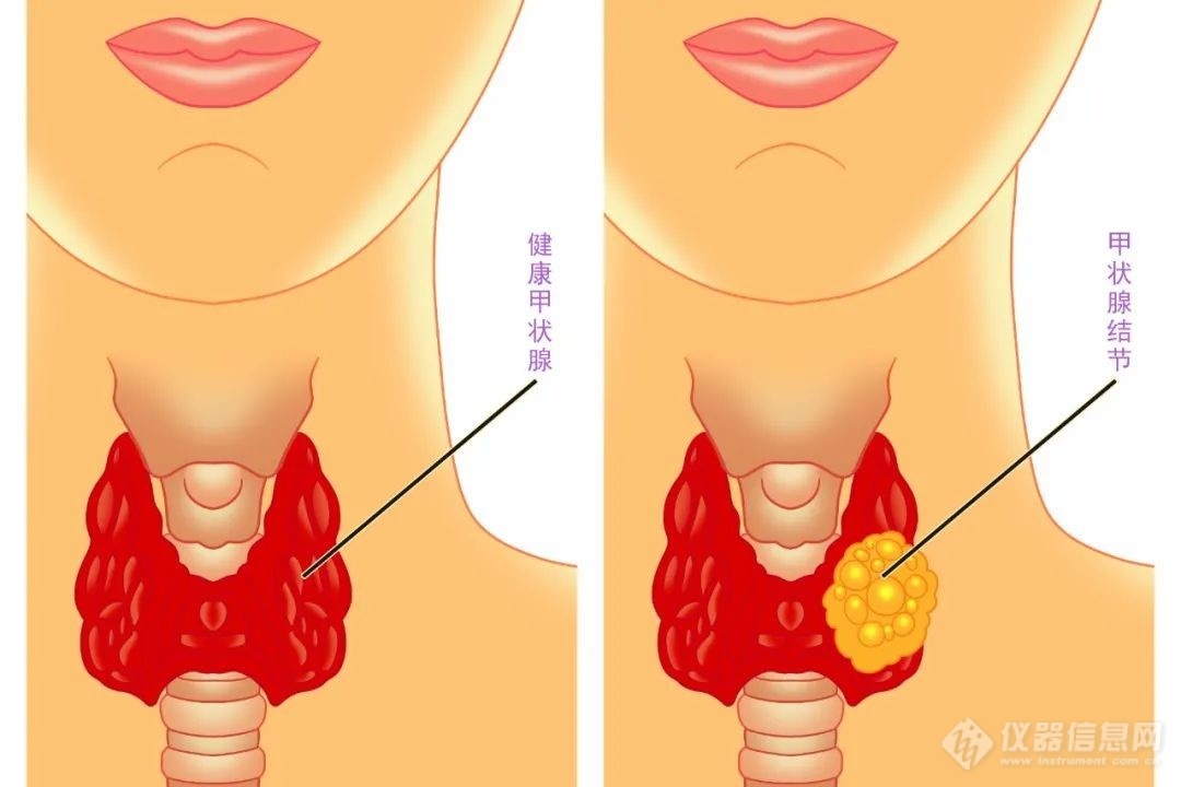 甲状腺是什么，你真的了解甲状腺疾病吗？｜科普系列（二）