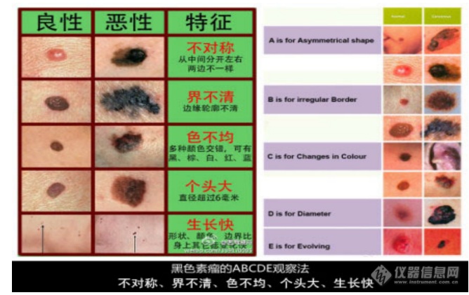 预防恶性黑色素瘤|主任医师李咏生:防晒至关重要