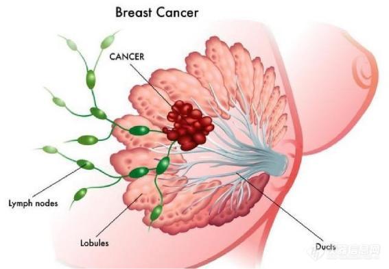 拉曼光谱在宫颈癌转移前哨淋巴结活检中的应用