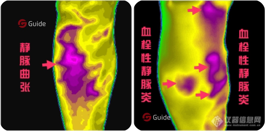 【综述】红外热像仪在医疗诊断中的应用