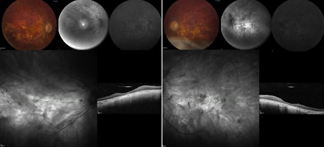 【案例研究】RPE65 基因治疗视网膜下注射：术中 OCT 的优点