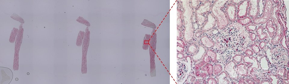 CD68（巨噬细胞）的肾小球占比分析事例