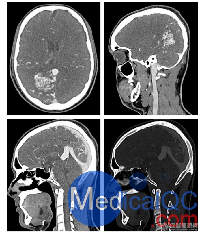 WEK51-04 CTA AVM头部模体,WEK51-04 CT血管造影头模成像效果图