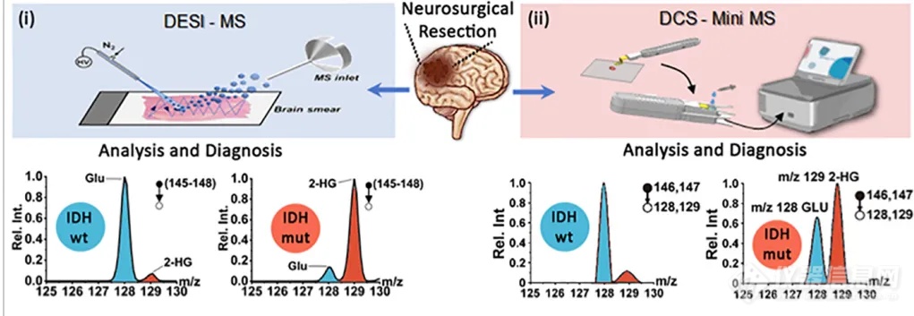 质谱POCT——90秒诊断脑胶质瘤术中分子病理
