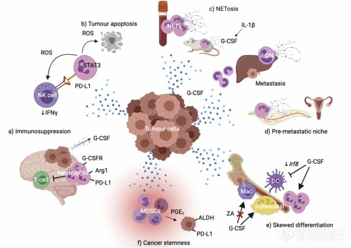 G-CSF在肿瘤中的表达