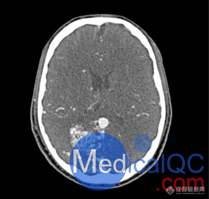 WEK-5005脑血管造影头模，WEK-5005头模， CTA AVM头模成像效果图