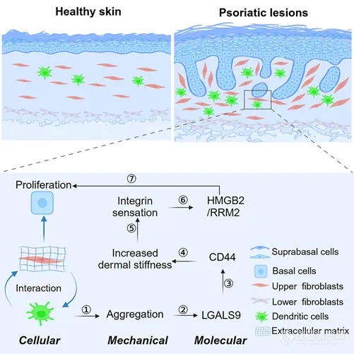 光子晶体生物力显微镜揭示银屑病患者皮肤杨氏模量异常：机械力-化学级联信号在发病过程中的关键作用