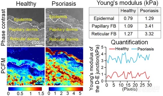 光子晶体生物力显微镜揭示银屑病患者皮肤杨氏模量异常：机械力-化学级联信号在发病过程中的关键作用