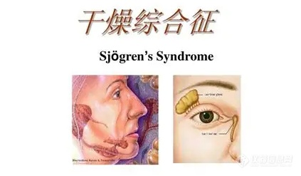 干燥综合征