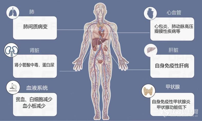 干燥综合征患者症状