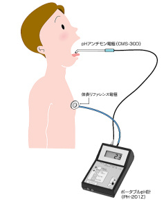 口腔内pH监视器