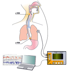 胃食管反流检查用pH监视器